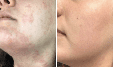 #1 Herbal Eczema Treatment Cream - All Natural