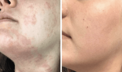 #1 Herbal Eczema Treatment Cream - All Natural