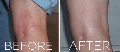#1 Herbal Eczema Treatment Cream - All Natural