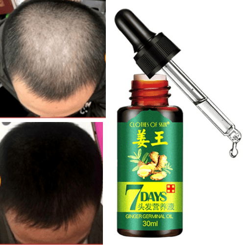#1 Hair Regrowth Oil - Hair Regrowth Solution - All Natural