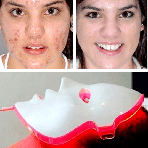 LED Light Therapy Facial Mask