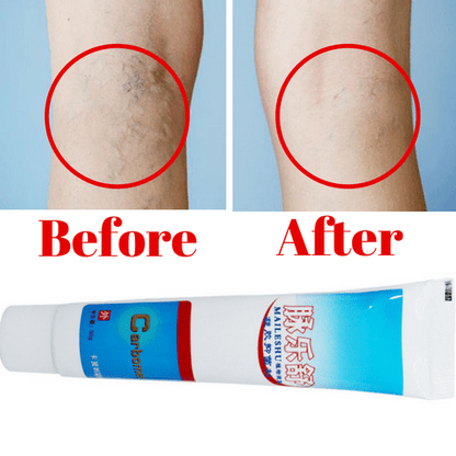 #1 Varicose Veins Treatment Cream - The Most Effective Varicose Veins Treatment