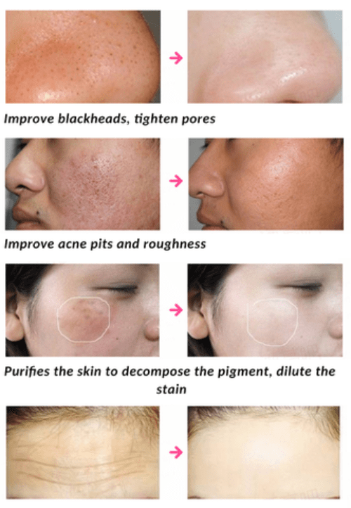 LED Light Therapy Facial Mask