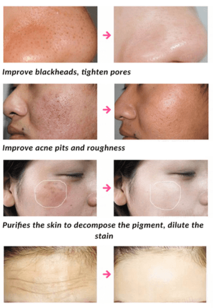 LED Light Therapy Facial Mask