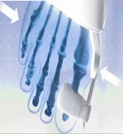 #1 Orthopedic Bunion Corrector Splints - Non-Surgical Relief & Treatment - Adjustable Pair