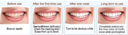 #1 Nano Teeth Whitening Kit - 10 pcs
