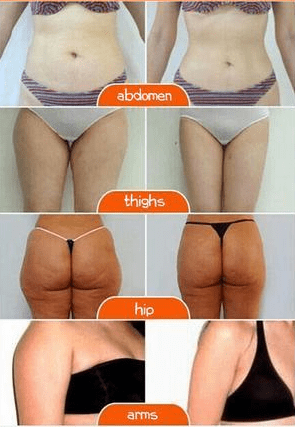 #1 Cellulite Treatment Cream - Cellulite Removal Cream