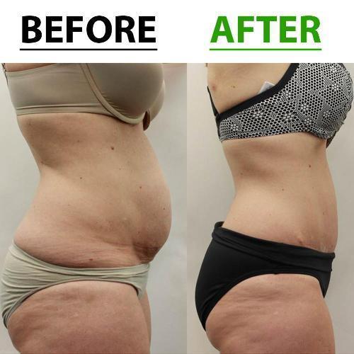 Belly Slimming Patch Set