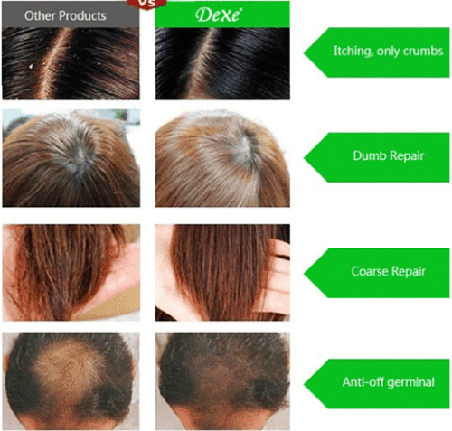 The Best Anti Hair Loss Shampoo