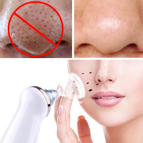 The Best Blackhead Remover