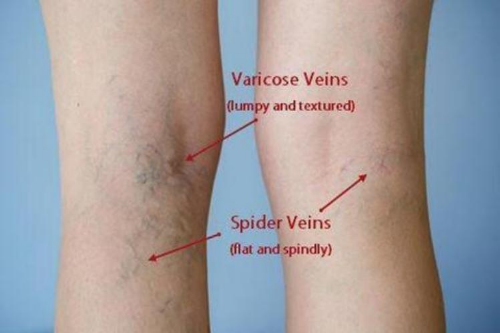 #1 Spider Veins Remover - Medical Blue Light Therapy Laser Treatment Pen