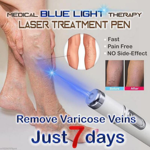 #1 Spider Veins Remover - Medical Blue Light Therapy Laser Treatment Pen
