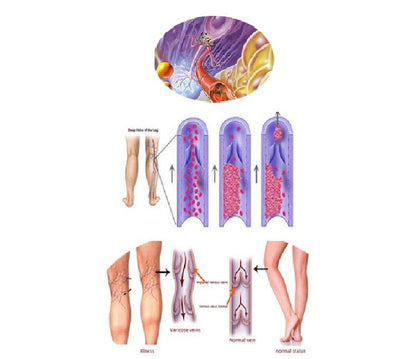 #1 Varicose Veins Treatment Cream - The Most Effective Varicose Veins Treatment