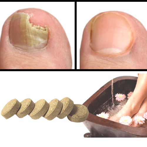 #1 Anti-Fungal Nail Treatment Detox Foot Soak