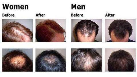#1 Natural Hair Regrowth Solution - Effective Hair Regrowth