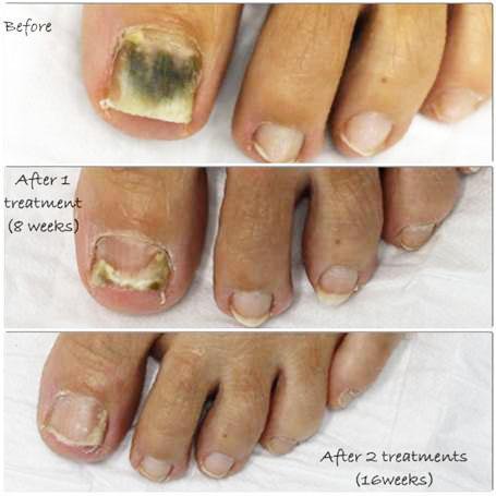 #1 Anti-Fungal Nail Treatment Detox Foot Soak