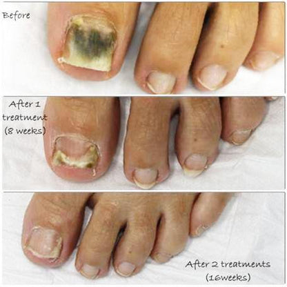 #1 Anti-Fungal Nail Treatment Detox Foot Soak