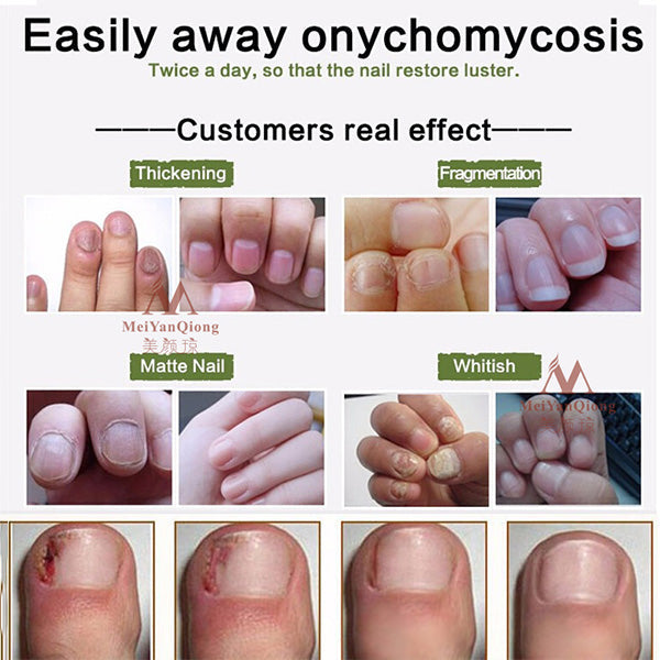 Nail Treatment Cream