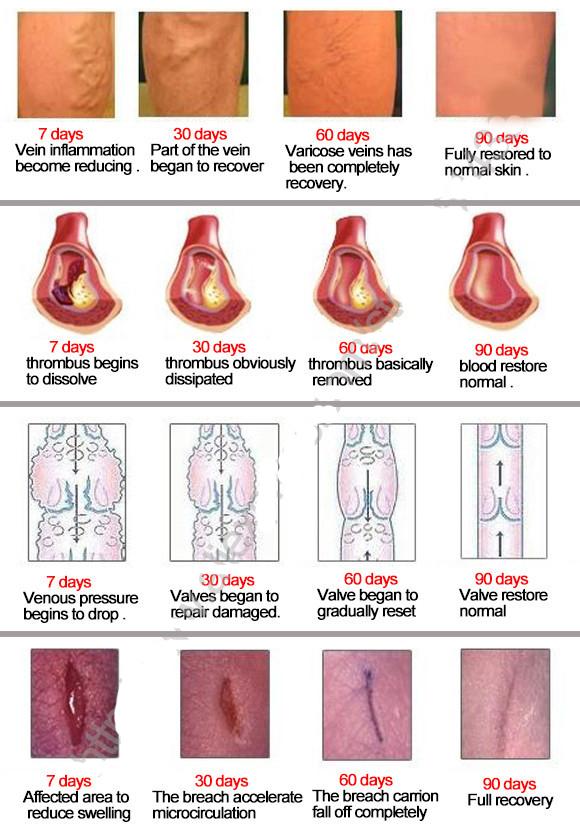 #1 Varicose Veins Treatment Cream - The Most Effective Varicose Veins Treatment