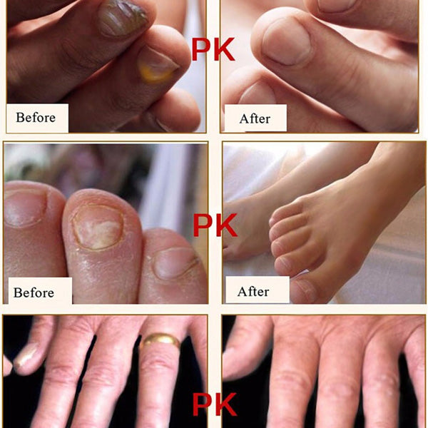 Nail Treatment Cream