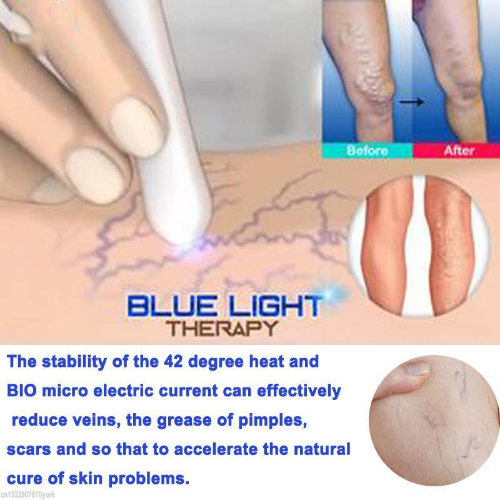 #1 Spider Veins Remover - Medical Blue Light Therapy Laser Treatment Pen
