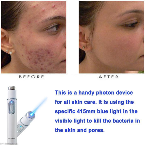 #1 Spider Veins Remover - Medical Blue Light Therapy Laser Treatment Pen