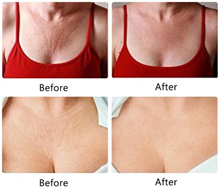 NEW Anti-Wrinkle Silicone Chest Pad